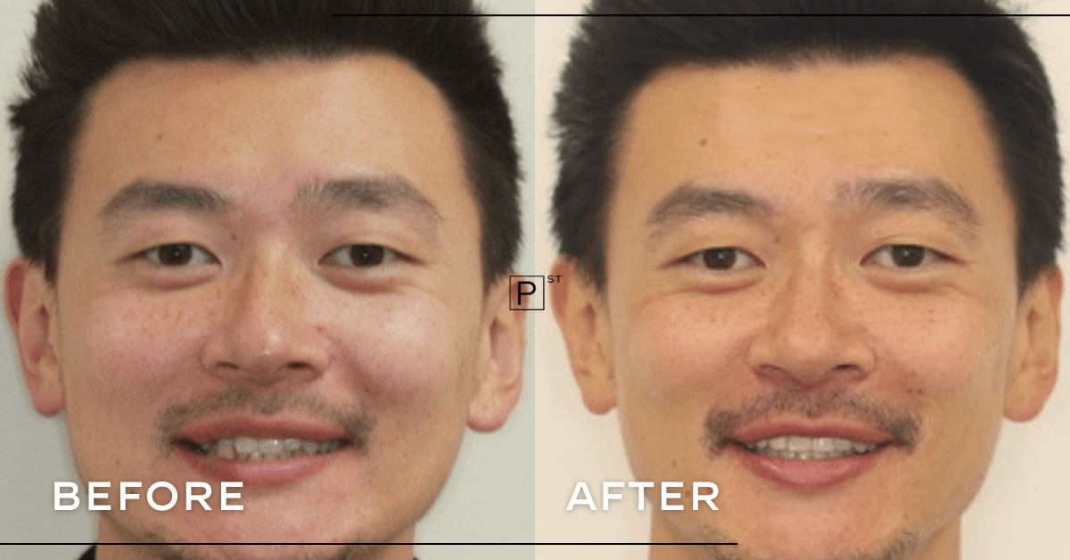 Rob-of-Burwoods-Invisalign-and-Veneer-Makeover-1
