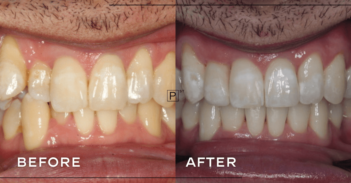Rob-of-Burwoods-Invisalign-and-Veneer-Makeover-3
