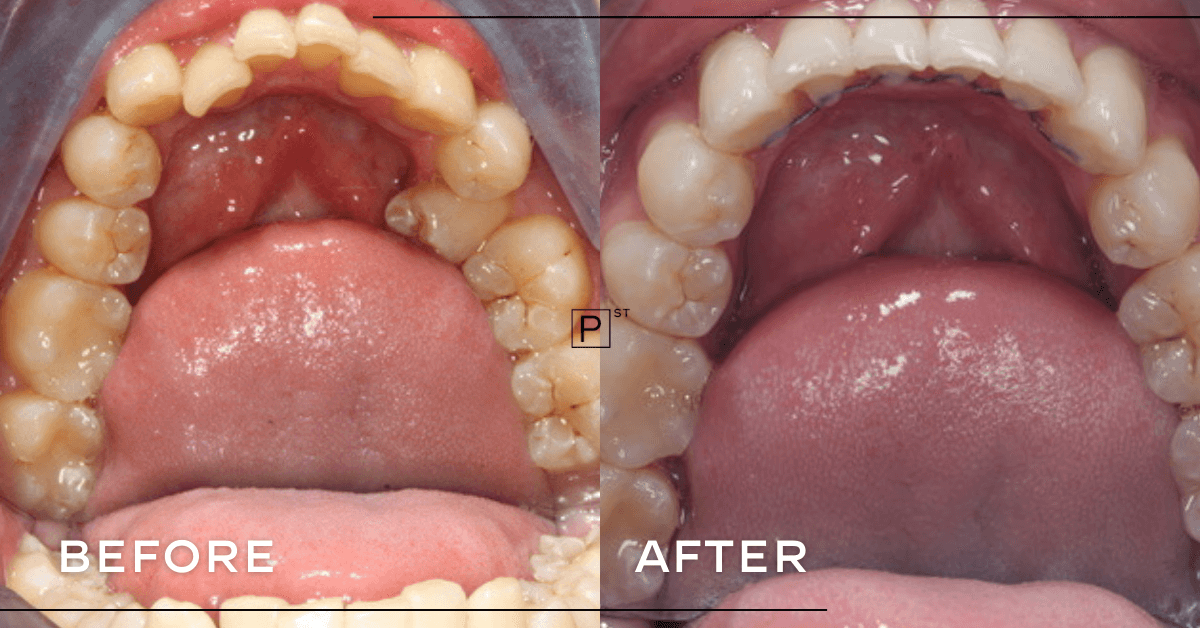 Rob-of-Burwoods-Invisalign-and-Veneer-Makeover-5