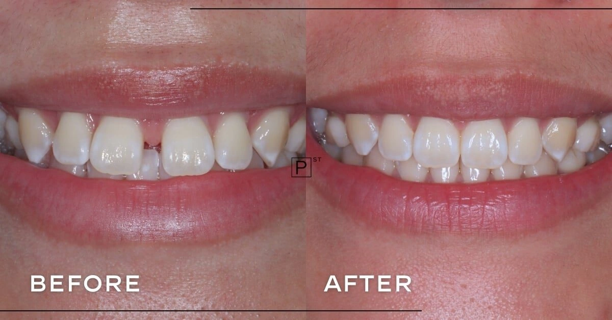 Helen of Glebe’s Invisalign, Dental Fillings, and Hygiene Smile Makeover Gallery image