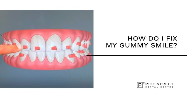 How Do I Fix My Gummy Smile?