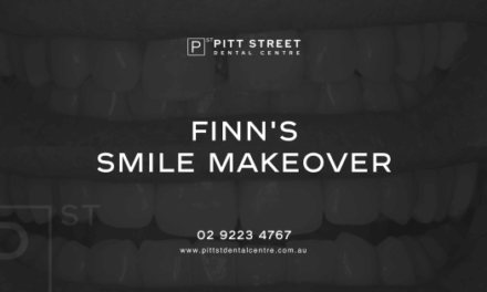 Finn Of Woolara’s Extraction, Graft, Implant and Veneers Makeover
