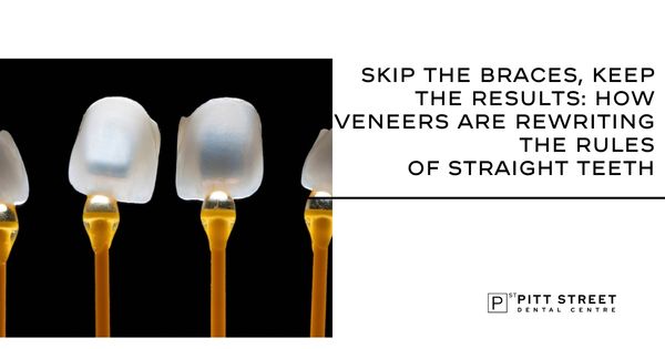 Skip the Braces, Keep the Results: How Veneers Are Rewriting the Rules of Straight Teeth
