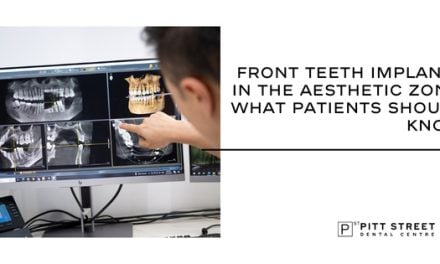 Front Teeth Implants in the Aesthetic Zone: What Patients Should Know