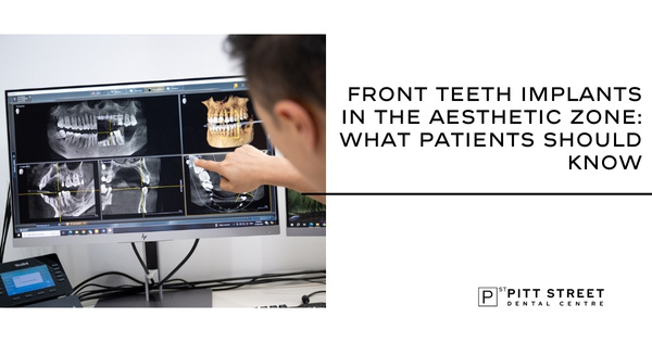 Front Teeth Implants in the Aesthetic Zone: What Patients Should Know
