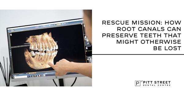 Rescue Mission: How Root Canals Can Preserve Teeth That Might Otherwise Be Lost