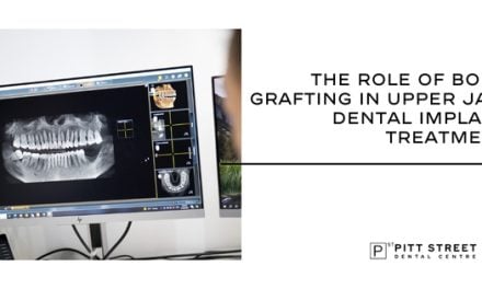 The Role of Bone Grafting in Upper Jaw Dental Implant Treatment