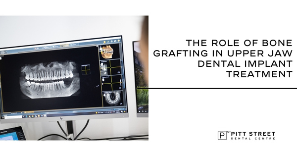 The Role of Bone Grafting in Upper Jaw Dental Implant Treatment