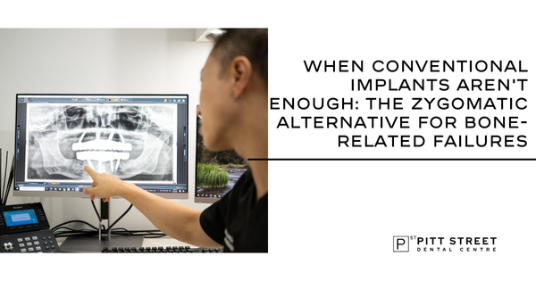 When Conventional Implants Aren&rsquo;t Enough: The Zygomatic Alternative for Bone-Related Failures