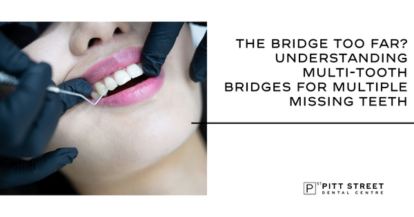 The Bridge Too Far? Understanding Multi-Tooth Bridges for Multiple Missing Teeth