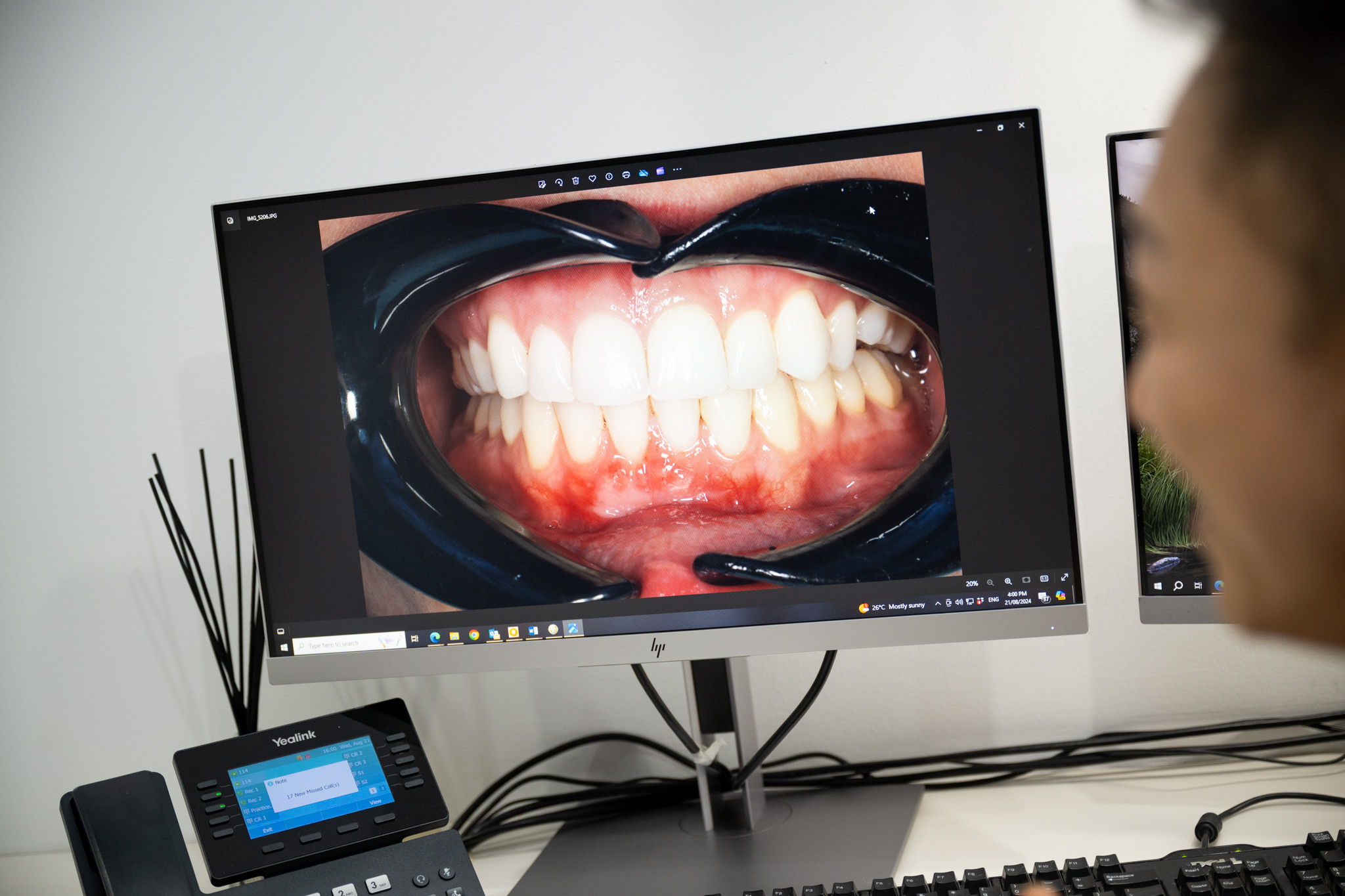 Teeth Whitening on Pitt Street: What to Expect in Sydney CBD