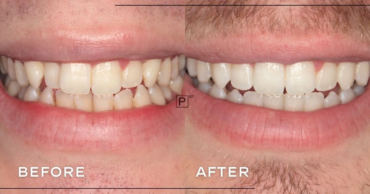 Adam of Pyrmont’s Invisalign, Whitening and Composite Bonding Makeover ...