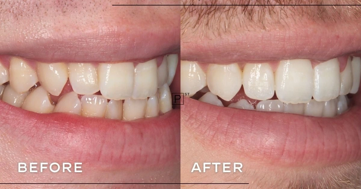 Adam of Pyrmont’s Invisalign, Whitening and Composite Bonding Makeover ...