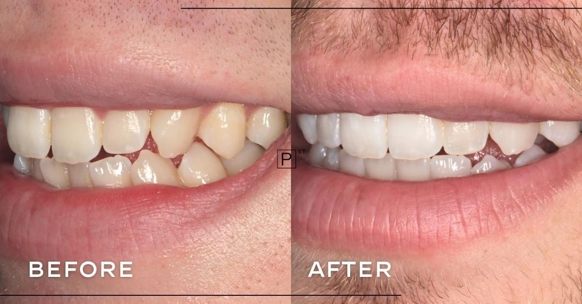Adam of Pyrmont’s Invisalign, Whitening and Composite Bonding Makeover ...
