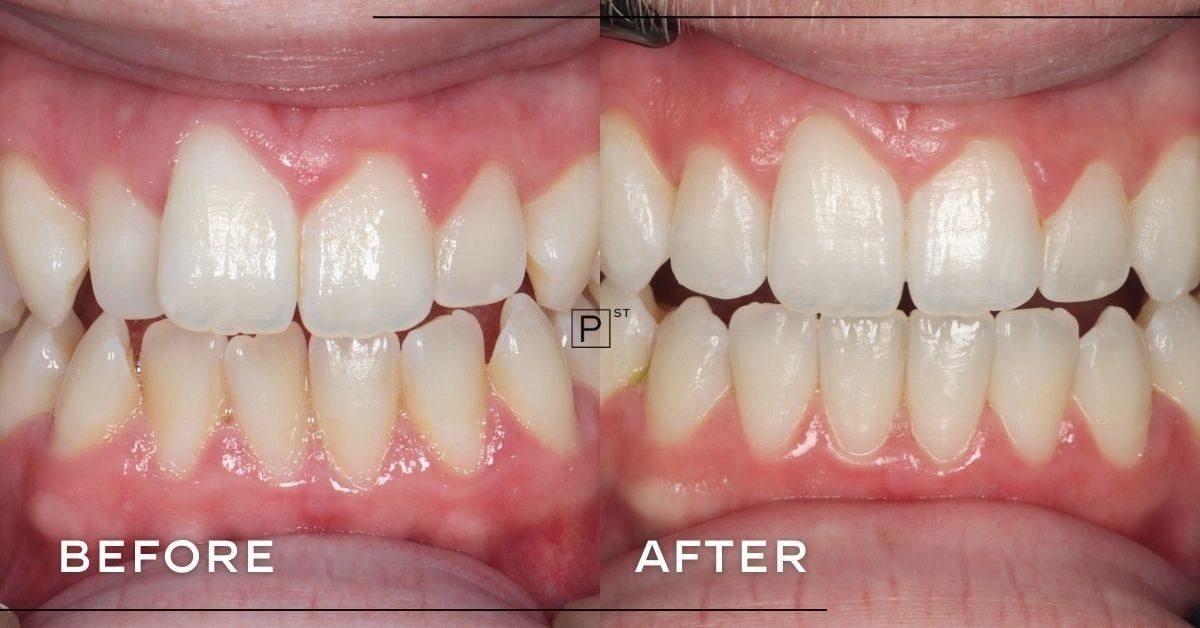 Adam of Pyrmont’s Invisalign, Whitening and Composite Bonding Makeover ...