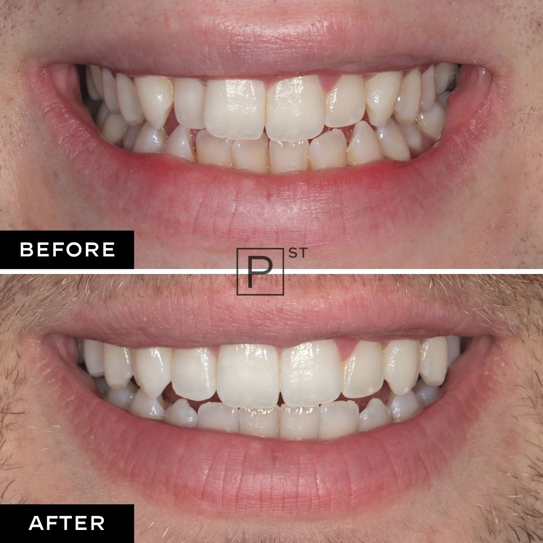 Adam of Pyrmont's Invisalign, Whitening and Composite Bonding Makeover