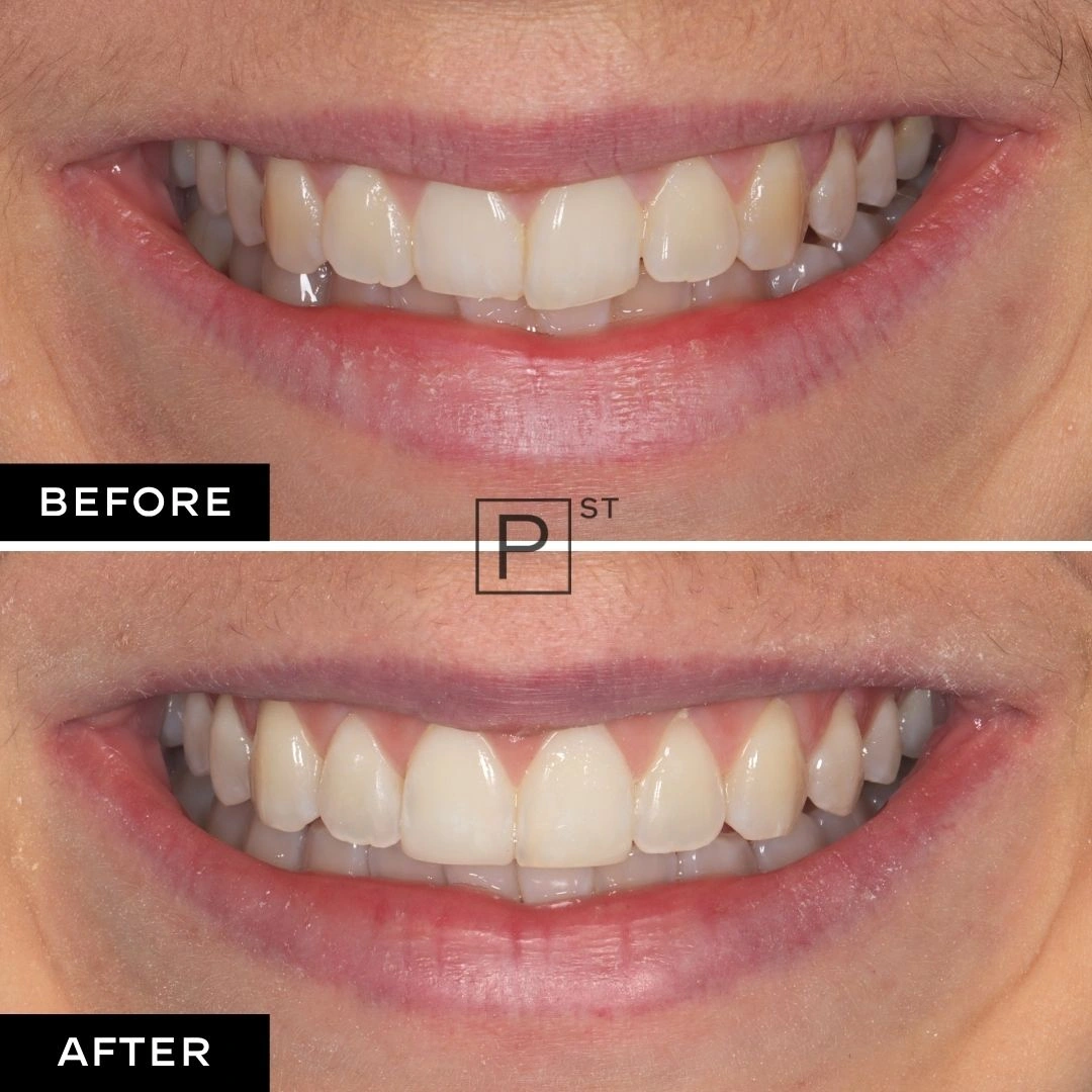 Bethany of Chatswood's Invisalign, Teeth Whitening, and Composite Bonding Makeover