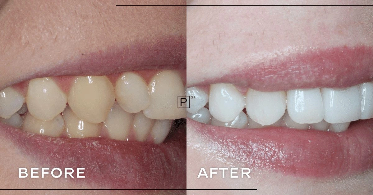 Catherine of Sydney’s Porcelain Veneers Makeover Gallery image