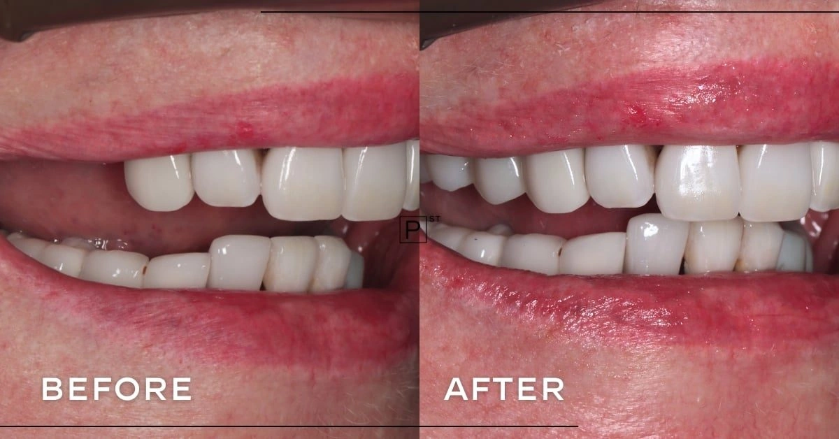 Ellie of Chatswood’s Dental Implant Makeover Gallery image