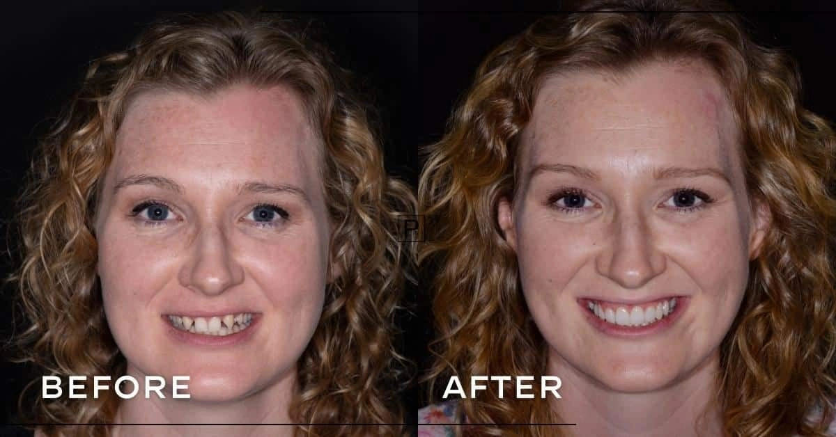 Can porcelain veneers and a dental bridge address congenitally missing teeth in Sydney? Gallery image