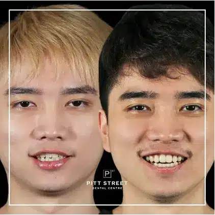Han of Waterloos Invisalign Makeover at Pitt Street Dental Centre