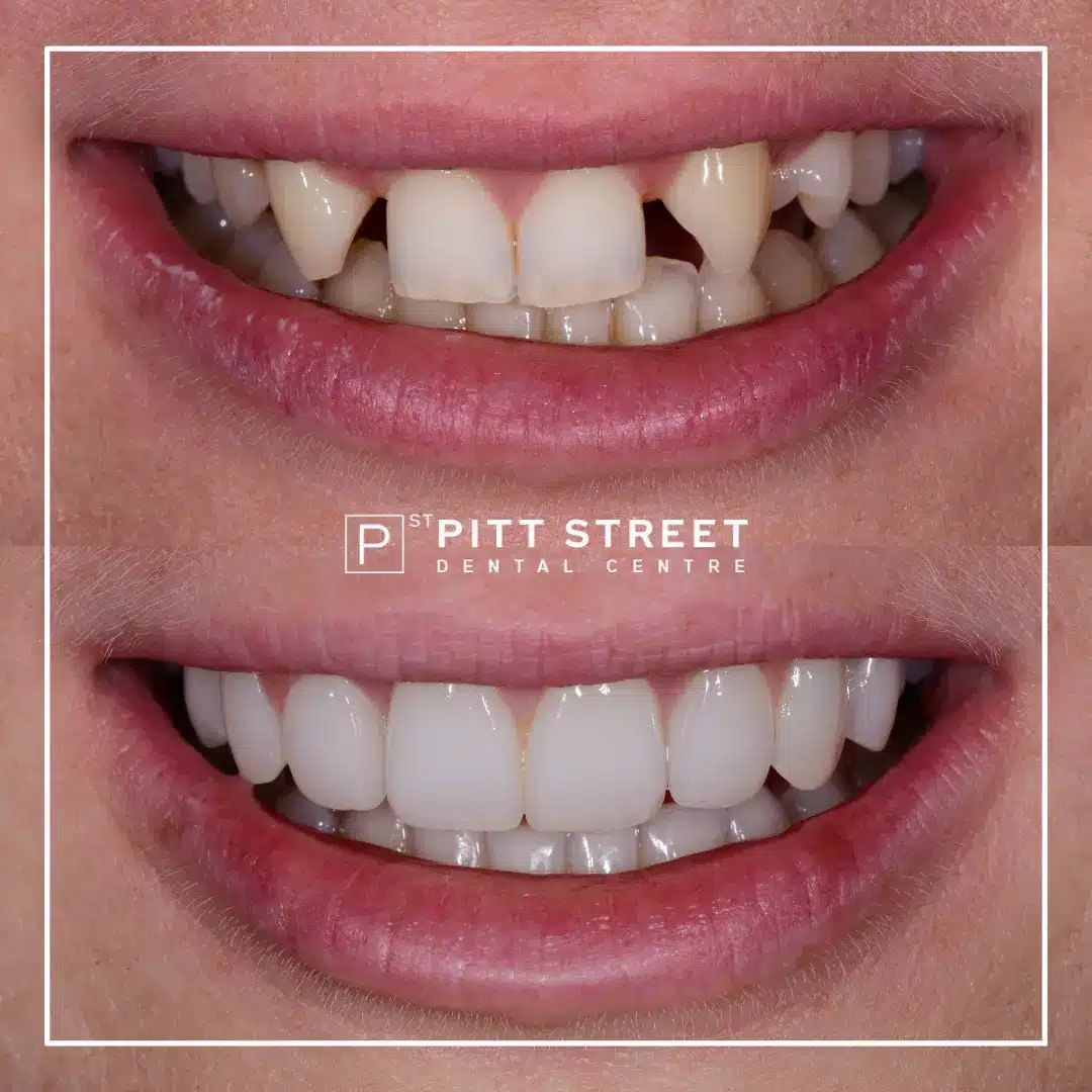 Helens Smile Makeover at Pitt Street Dental Centre