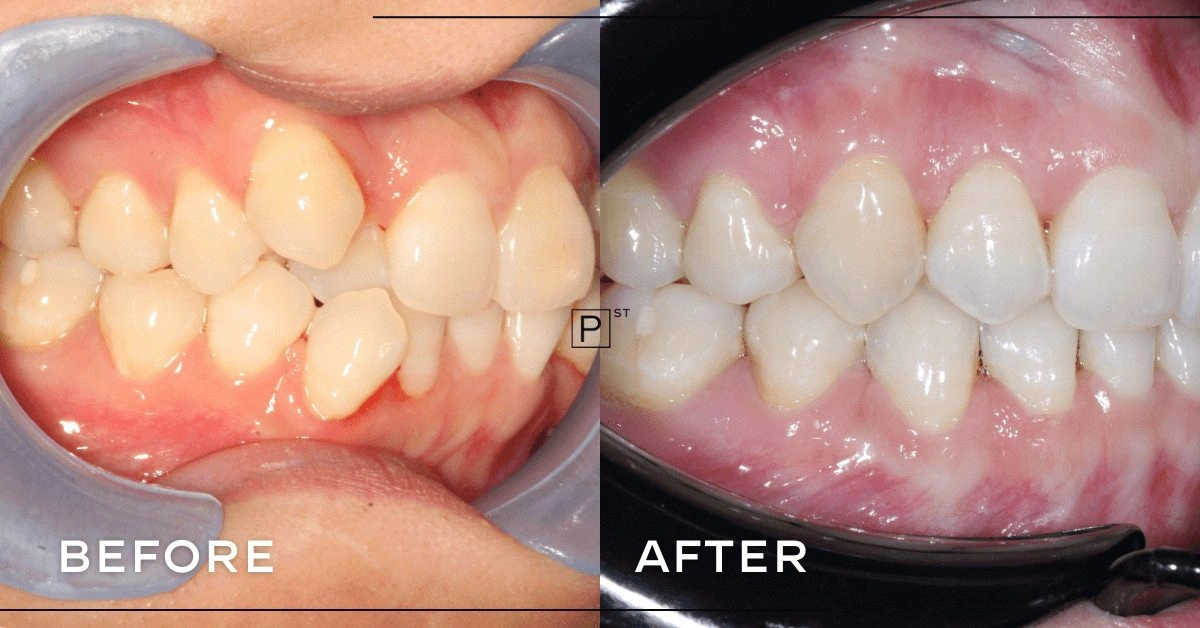 Can wisdom tooth removal and Invisalign address crowding and gingivitis in Sydney? Gallery image