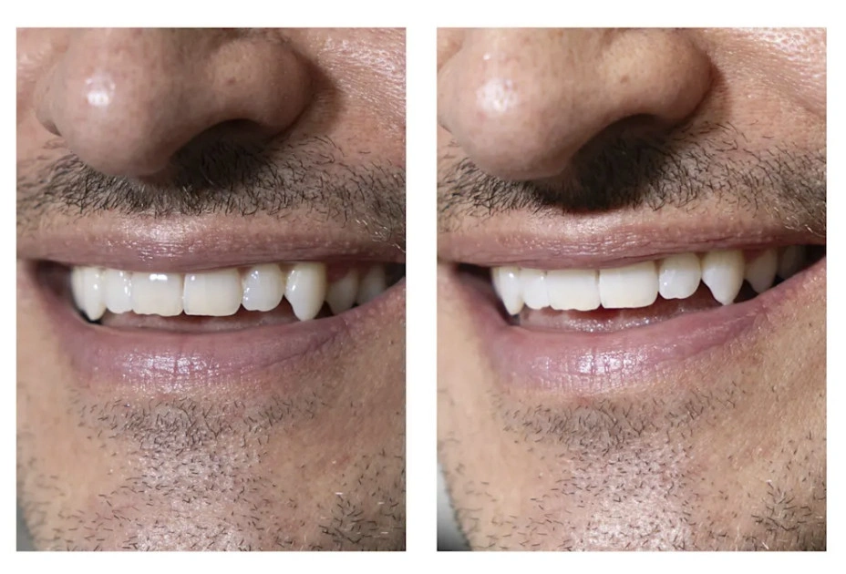 Jean Carre’s teeth before and after whitening. JANIE BARRETT