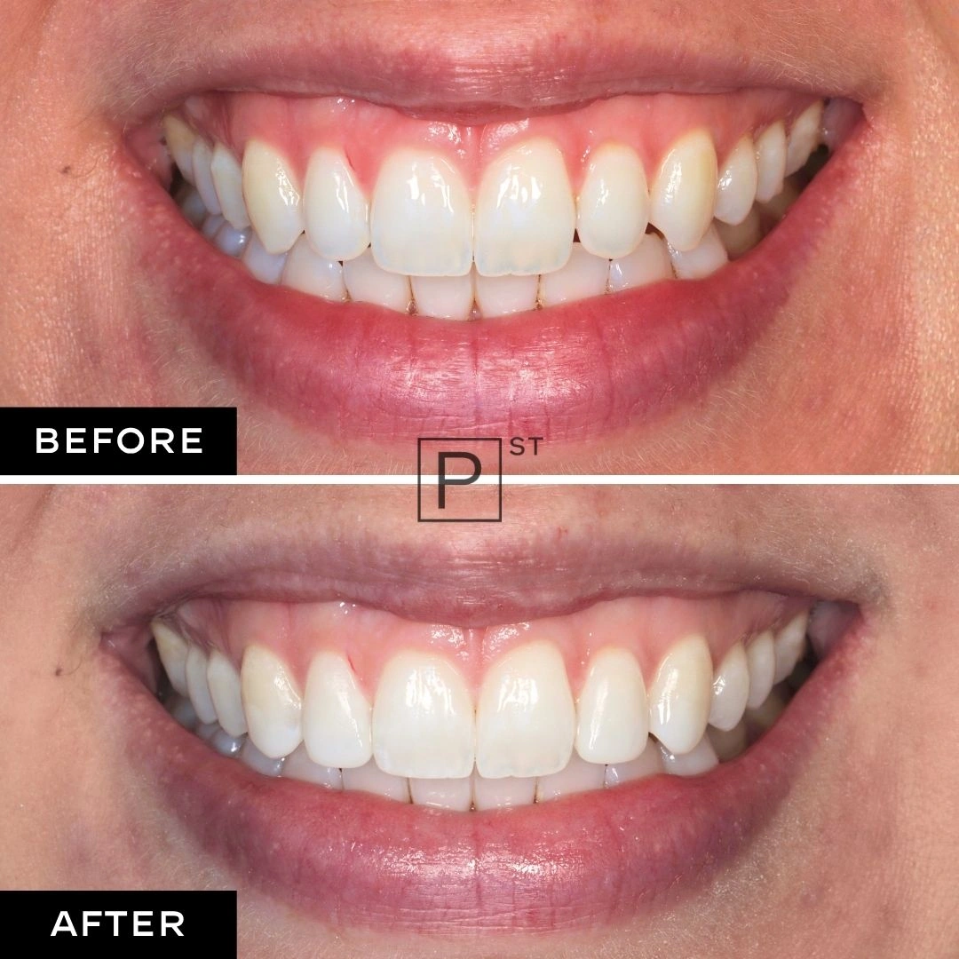 Jellisa of Bondi’s Composite Bonding and Teeth Whitening Makeover