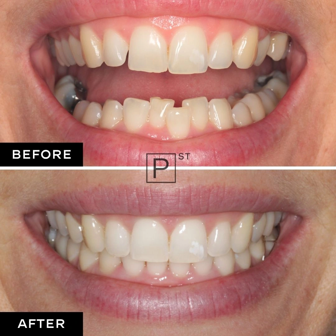 Jillian of Waterloo’s Invisalign, Dental Implants, and Whitening Makeover