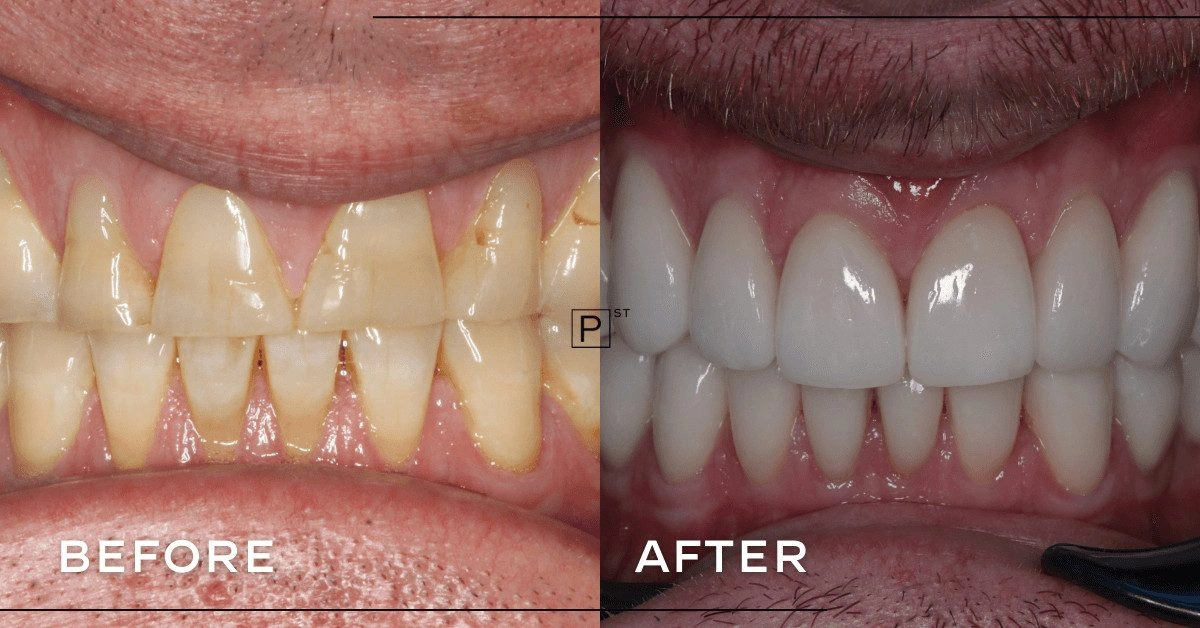 John of Annandale’s Veneers Makeover Gallery image