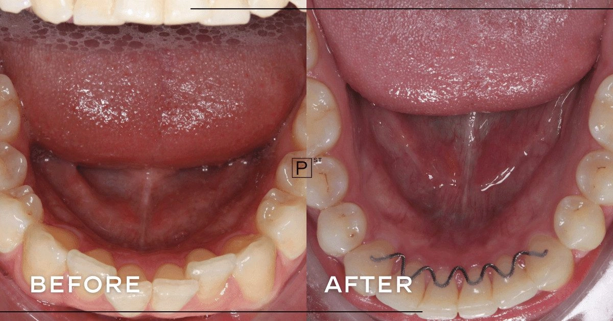 John Of Pyrmont’s Fillings, Wisdom Teeth Removal And Invisalign Makeover Gallery image