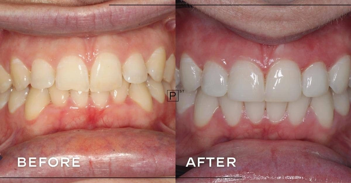 Can wisdom tooth removal, Invisalign and composite bonding address crowding and chipped teeth in Sydney? Gallery image