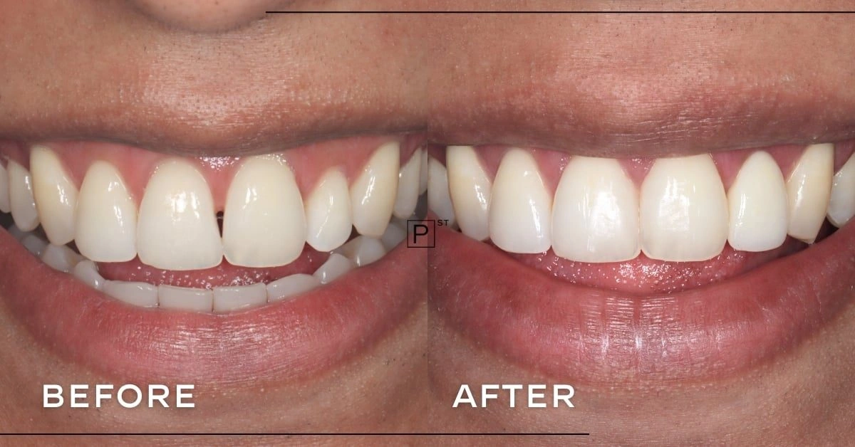 Khan of Potts Point’s Porcelain Veneers and Composite Bonding Makeover Gallery image
