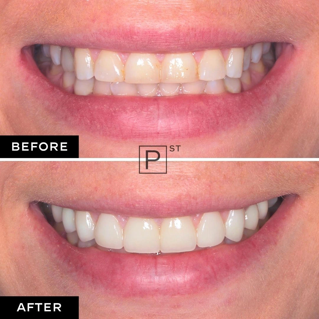 Lea of Castle Hill's Veneers, Invisalign and Whitening Smile Makeover