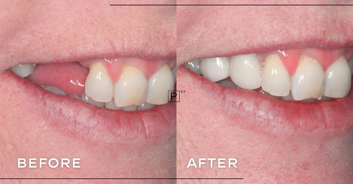 Liz of Northbridge’s Dental Implant Makeover Gallery image