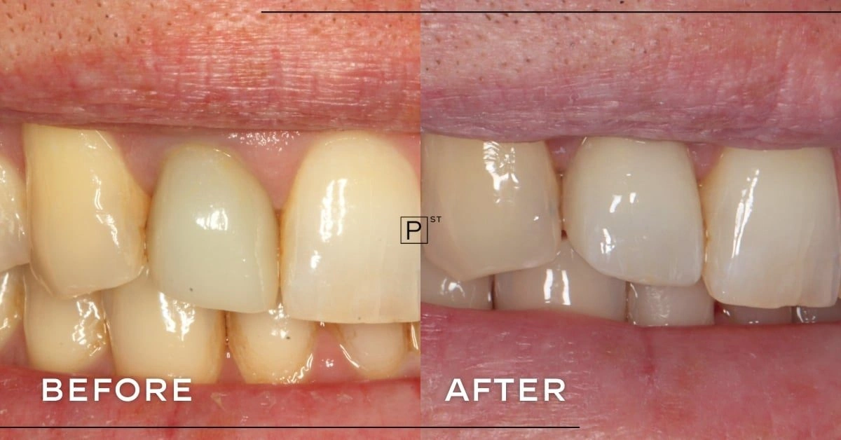 Mark of Dee Why’s Dental Implant Makeover Gallery image