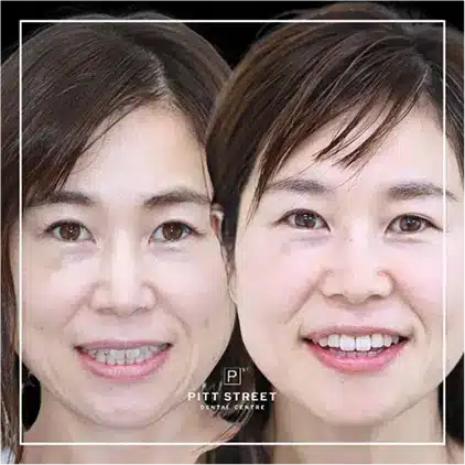 Masayo of Northbridges Invisalign Makeover at Pitt Street Dental Centre