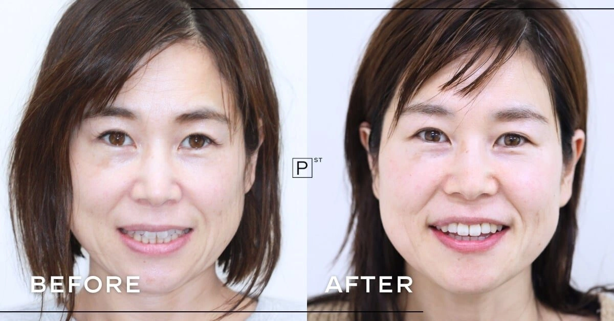 Masayo of Northbridge’s Invisalign Makeover Gallery image