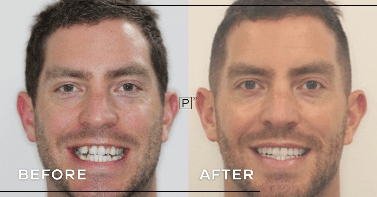 Can Invisalign, composite bonding and porcelain veneers address misalignment in Sydney? Gallery image