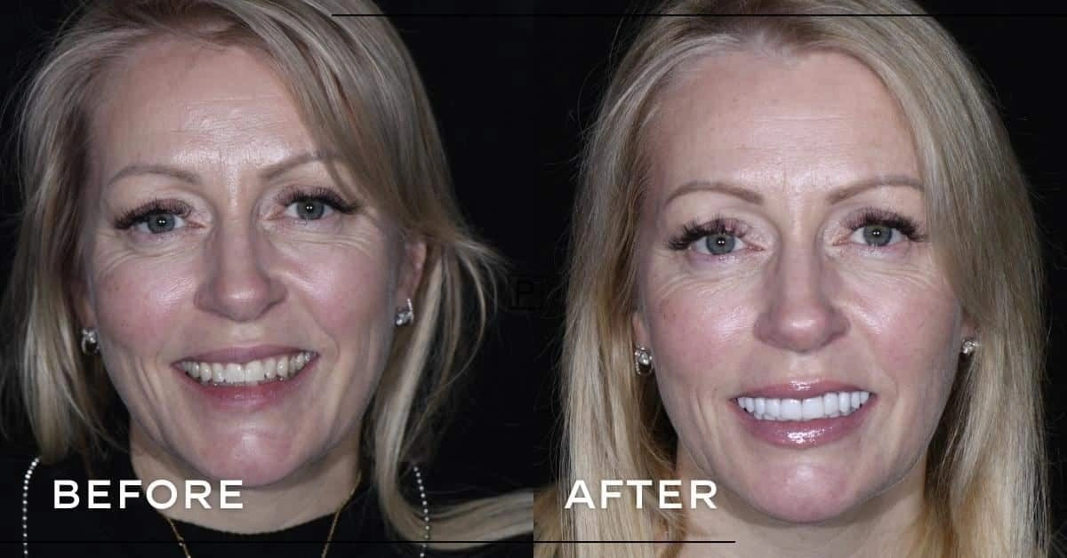 Can porcelain veneers address worn and crowded teeth in Sydney? Gallery image