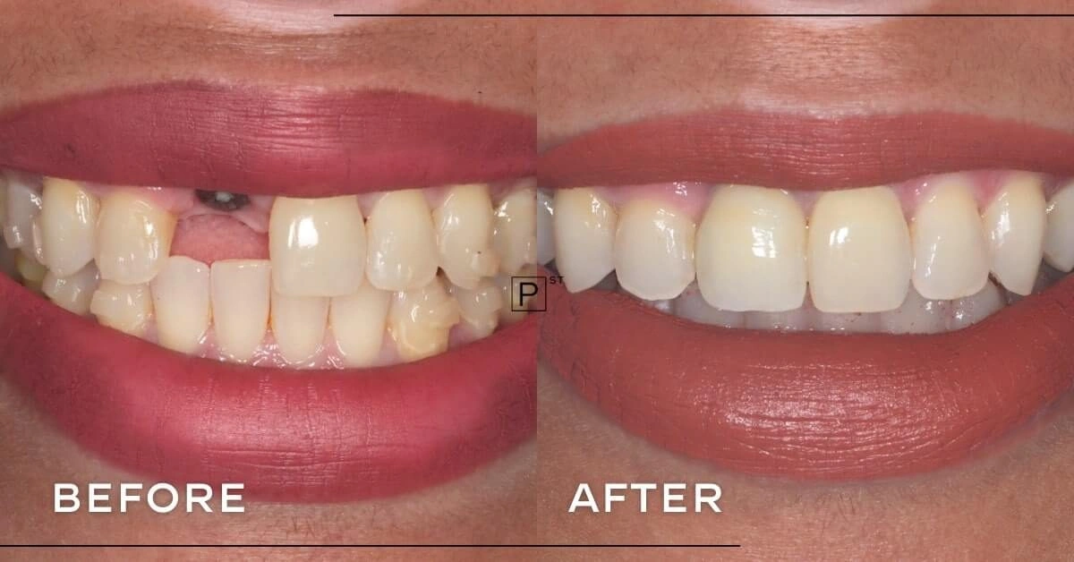 Sara of Pyrmont’s Invisalign and Dental Implant Makeover Gallery image