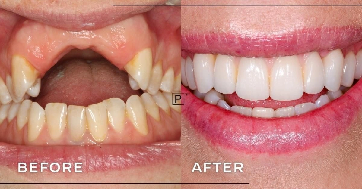 Can Invisalign, veneers and implants replace a denture and straighten crowded teeth in Sydney? Gallery image
