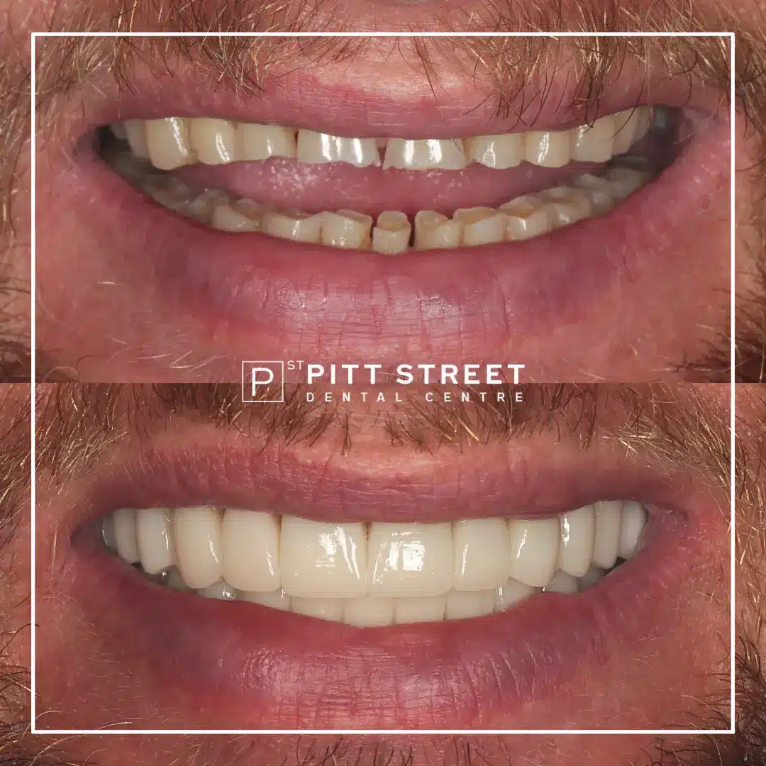 Smile Makeover at Pitt Street Dental Centre