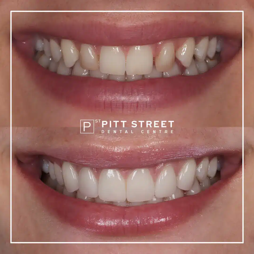 Smile Makeover at Pitt Street Dental Centre