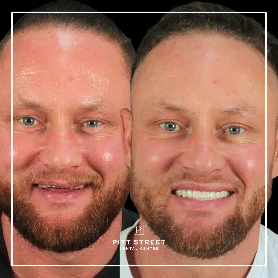 Smile Makeover at Pitt Street Dental Centre