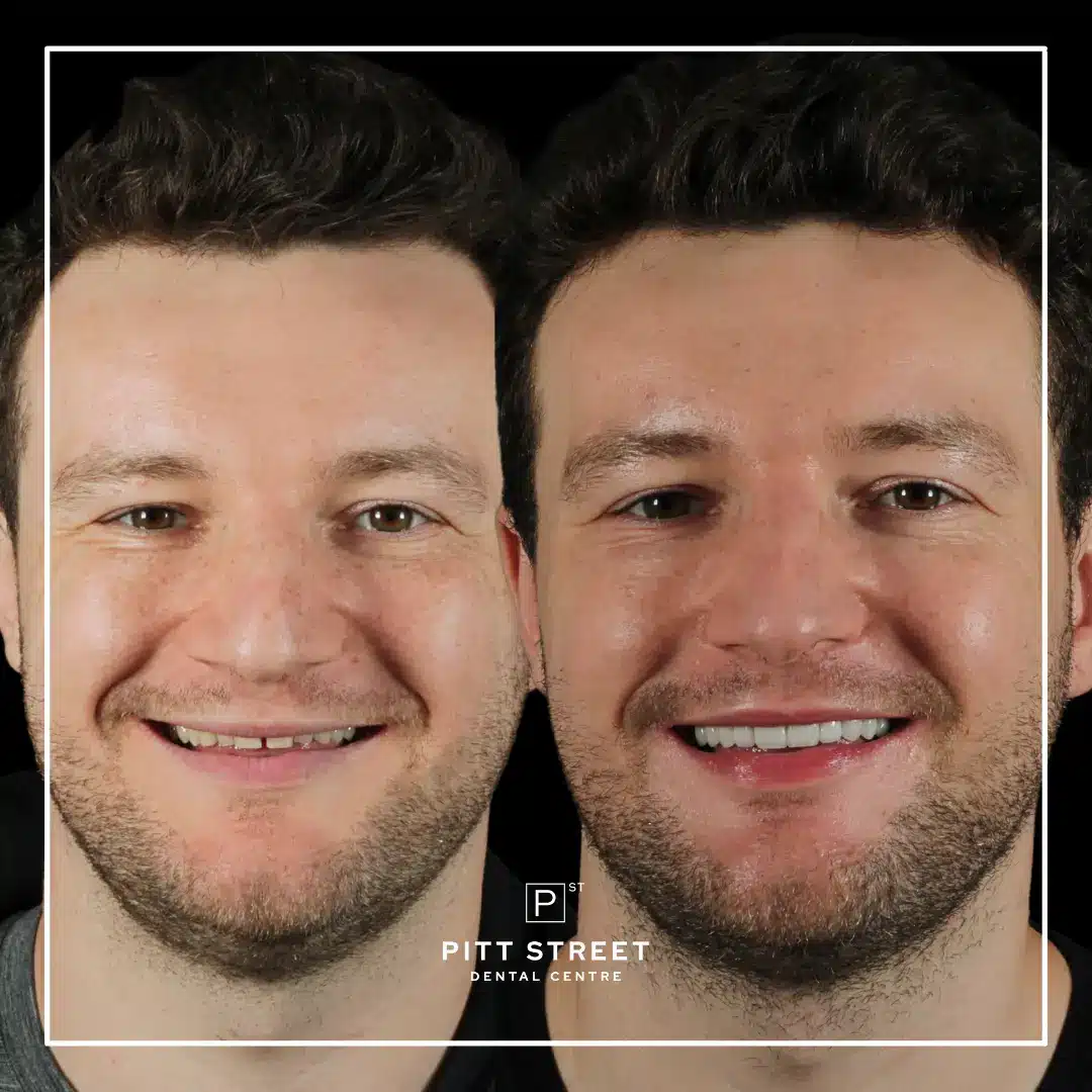 Smile Makeover at Pitt Street Dental Centre