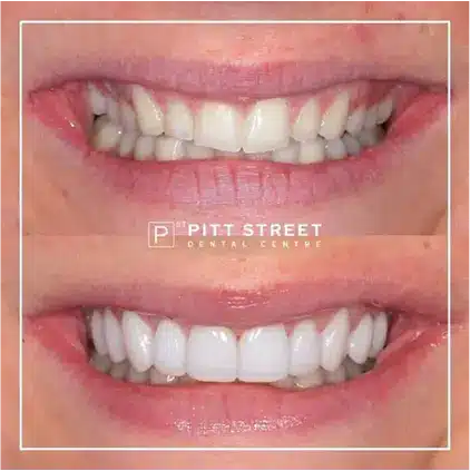 Smile Makeover at Pitt Street Dental Centre
