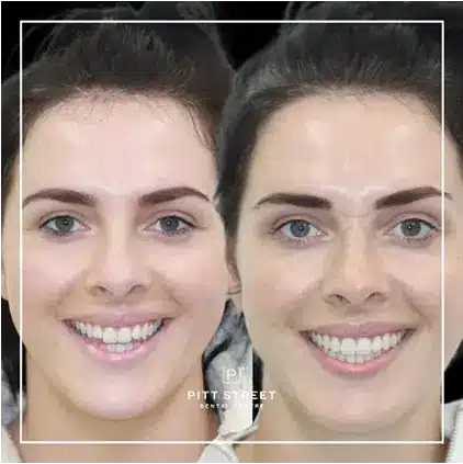 Smile Makeover at Pitt Street Dental Centre