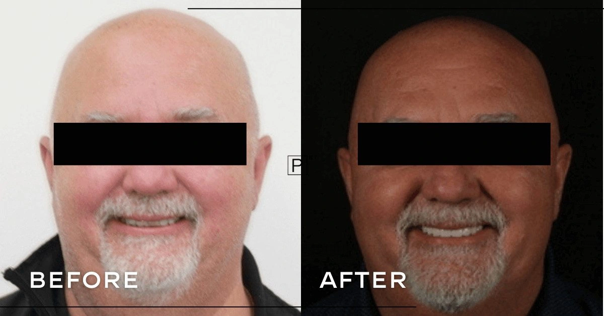 Steve of Coffs Harbour’s Dental Implants Makeover Gallery image